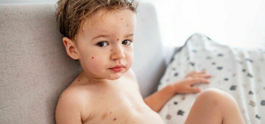 Vattkoppor hos barn – smittsamhet, symtom och så lindrar du
