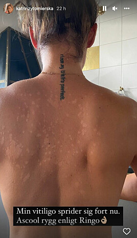 Katrin Zytomierska berättar att hon drabbats av hudsjukdomen vitiligo.